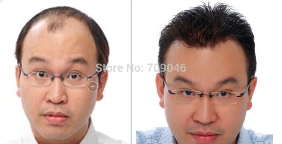 how to regrow hair loss from extensions
